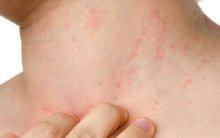 Общая потница у взрослых и способы её устранения