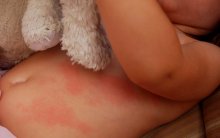 Как выглядит потница у грудничков: фото и рекомендации