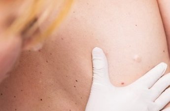 Симптомы и причины возникновения липомы