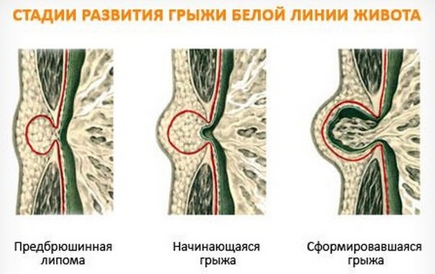 предбрюшинная липома или грыжа