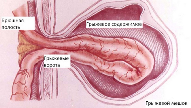 параумбиликальная грыжа